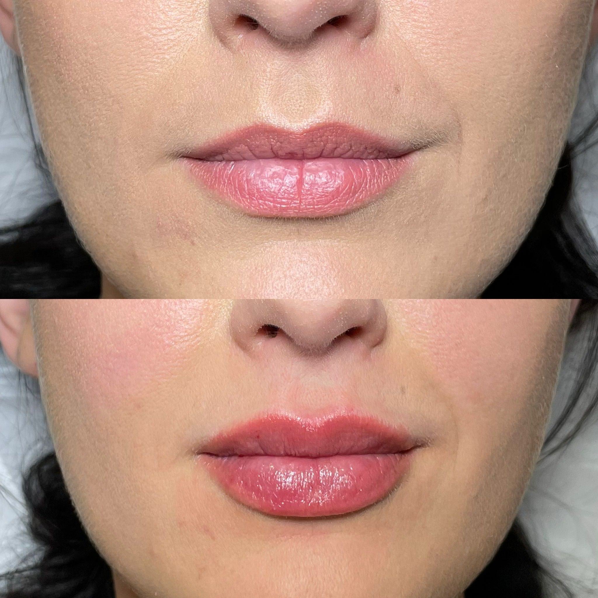 Lip Fillers, Botox, Dermal Fillers, Anti-Wrinkle Injections in Bushey Mead SW20